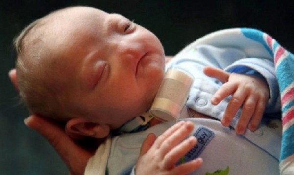 Роден без нос: Аномалията на бебето Ели