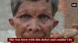 63 годишната индийка Кумар Айкак е с необичайно количество пръсти