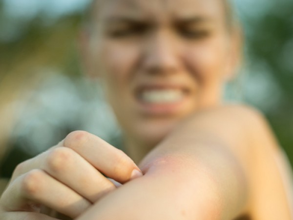 Ухапванията от насекоми предизвикват истинска вълна от неприятни симптоми –
