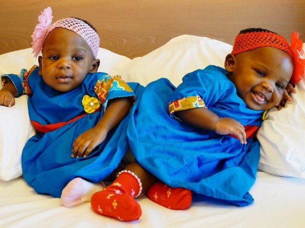 16-месечните сиамски близнаци Елизабет и Мери от Камерун бяха изписани