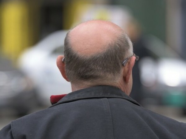 Загубата на коса е много по-разпространена сред мъжете, отколкото сред