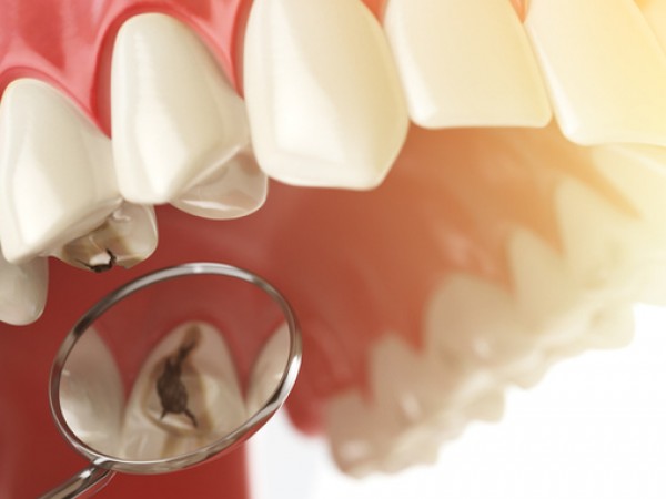 Кариесът е едно от най-разпространените заболявания, които засягат зъбите. То