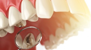 Кариесът е едно от най разпространените заболявания които засягат зъбите То