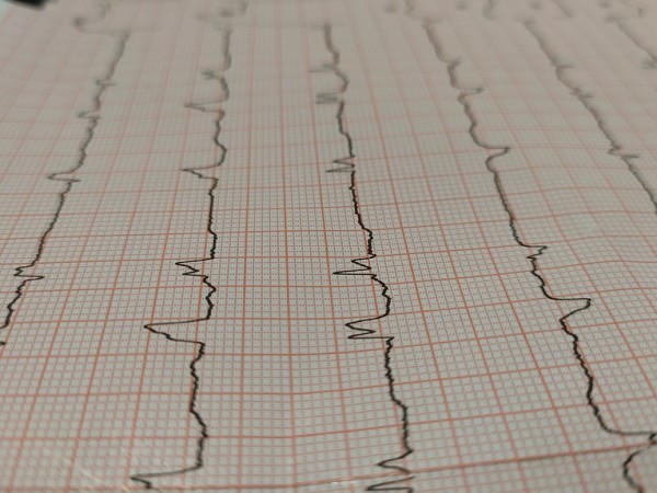 Инфарктите сред младите хора зачестяват, съобщи ЮПИ. Според данните инфарктите