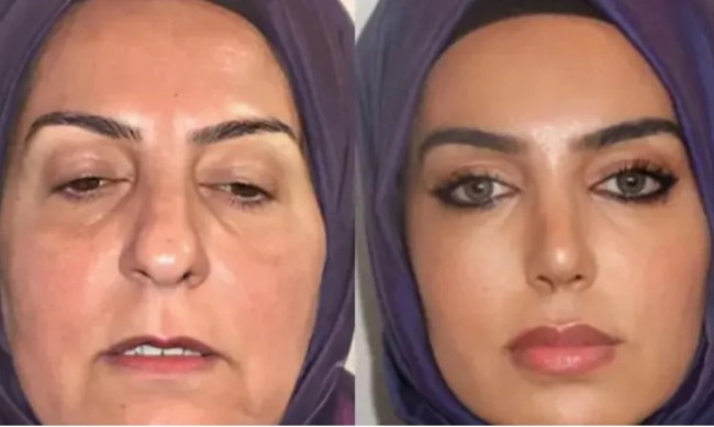 Клиника по естетична хирургия предизвика скандал в Турция: Скалпелът или фотошопът има пръст?